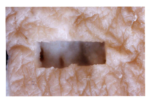 Photograph of human skin, in vitro, photoetched by excimer laser